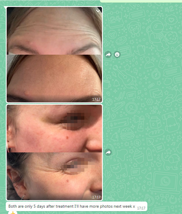 botulax reviews