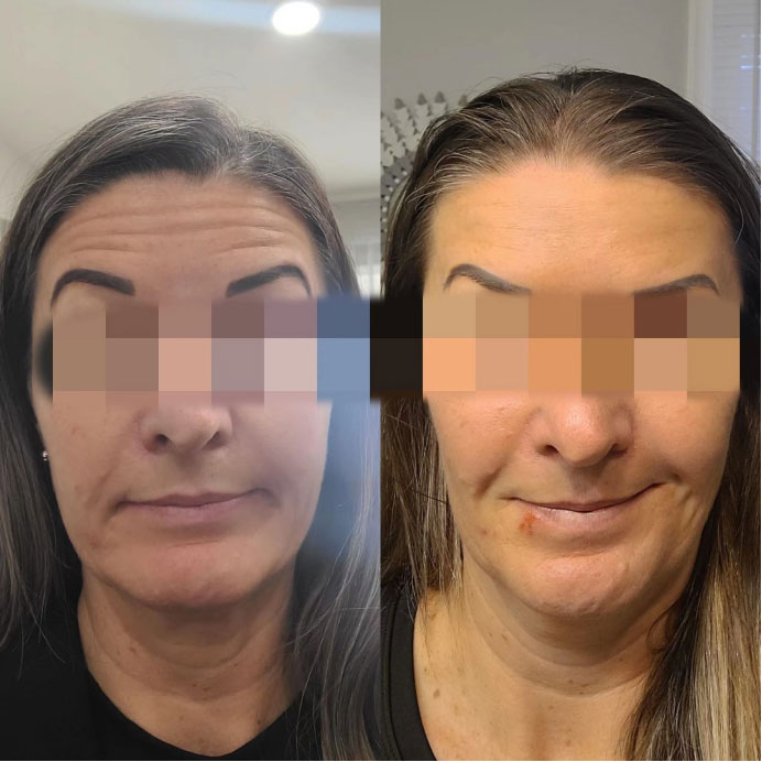 how long does botulinum toxin take to work