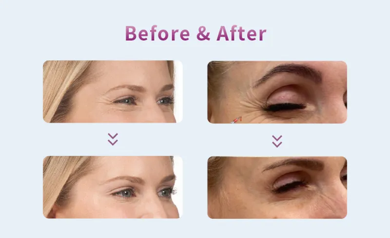 Before and after Botulax injection
