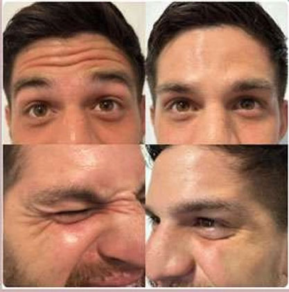 botulinum toxin for men befor and after