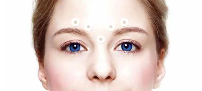 Glabella-Lines-Injection-Method