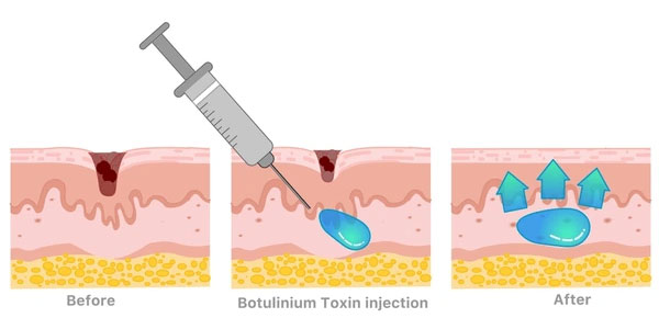 difference between dermal filler and botulinum toxin