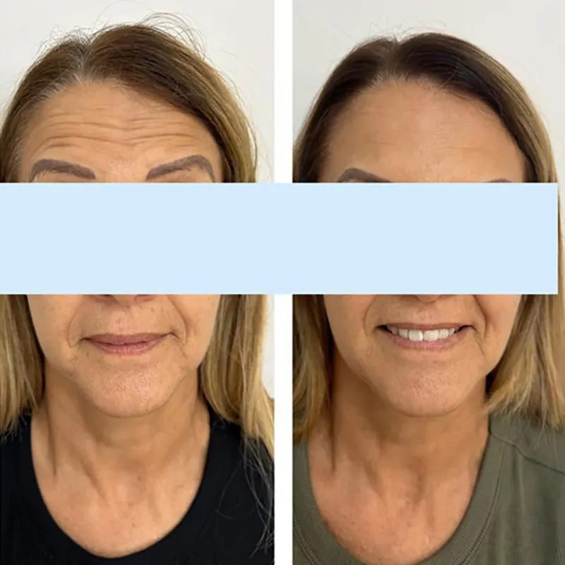 Toxara-Botulinum-Toxin-Injections-Before-&-After