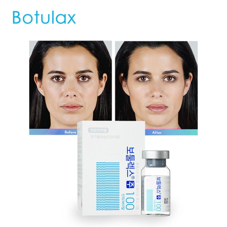 botulax before and after