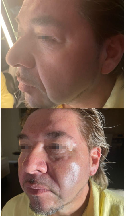 botulinum toxin for facial harmony