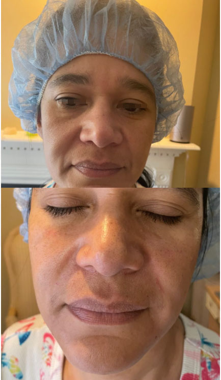 botulinum toxin for facial harmony