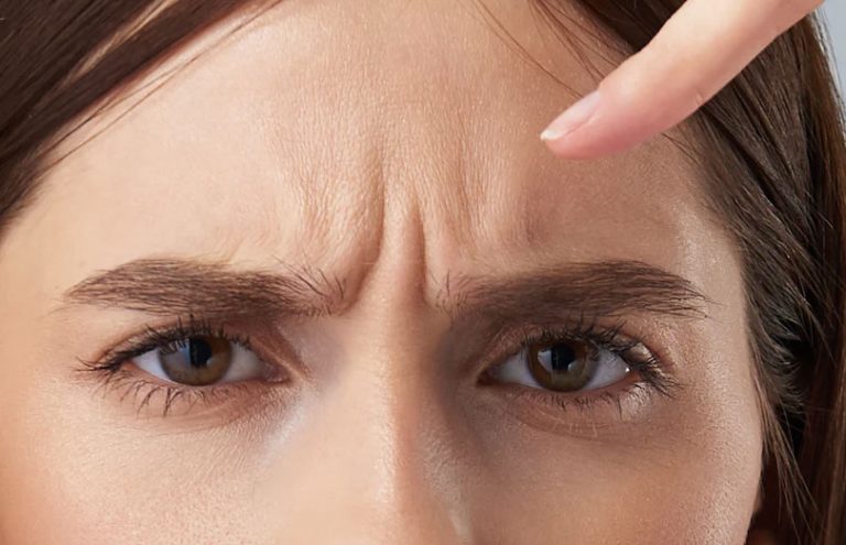 botulinum toxin for frown lines