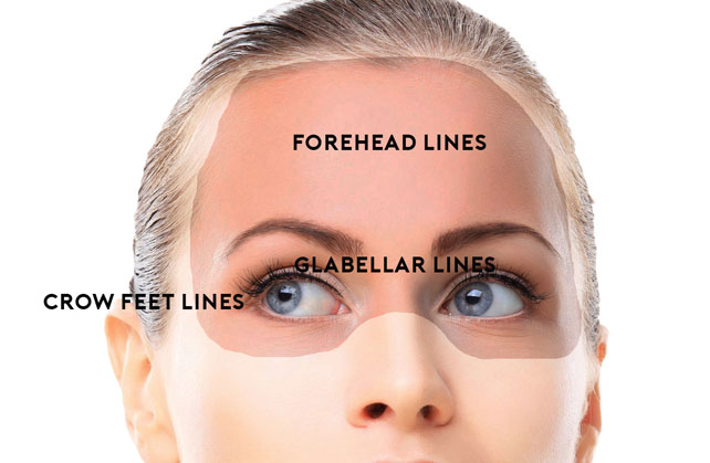 botulinum toxin injection points