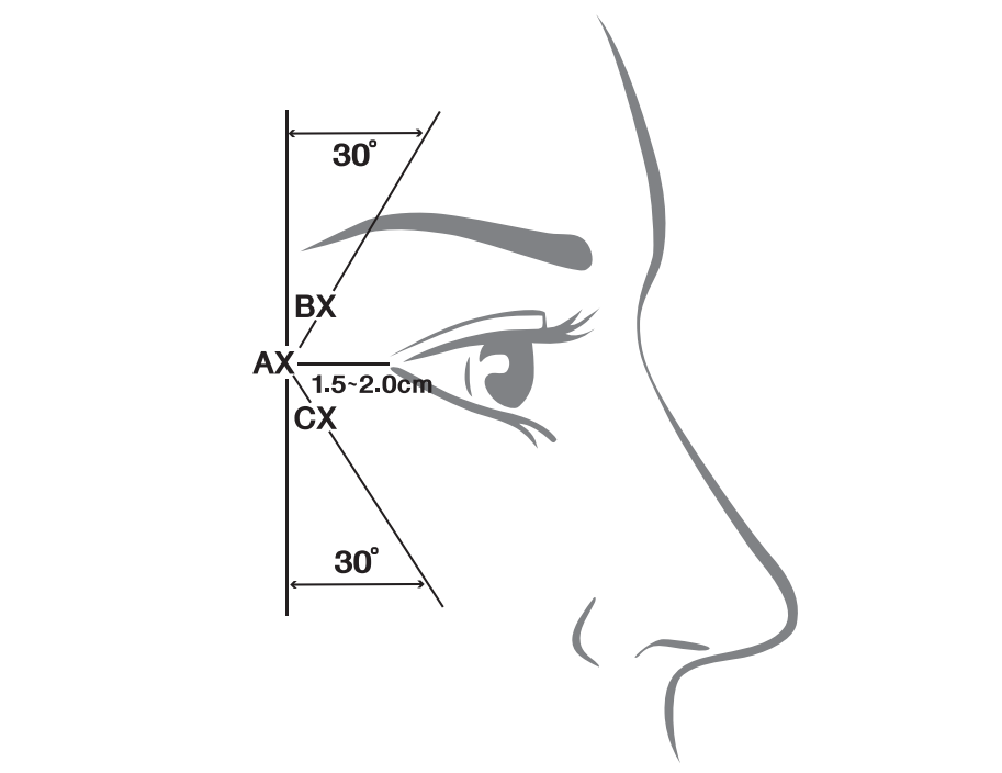 Botulinum Toxin Injection Points