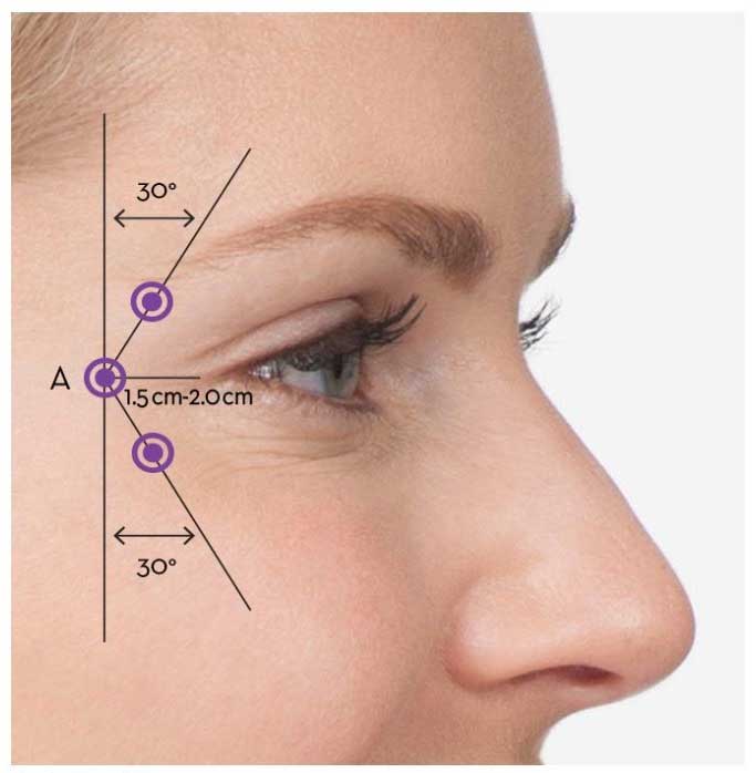 Botulinum Toxin for Crow's Feet