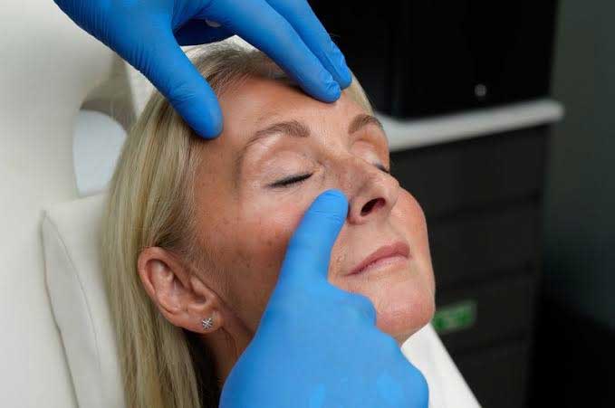 botulinum toxin for under eye wrinkles