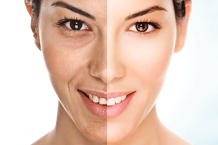 botulinum toxin for anti aging