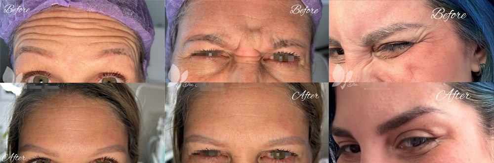 is Nabota botulinum toxin good