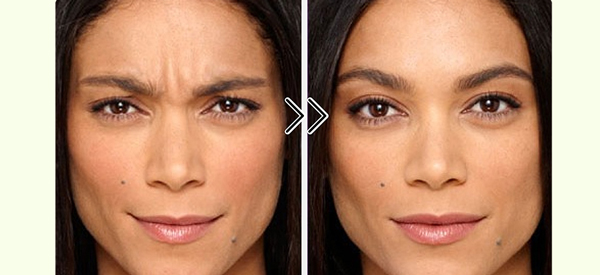 What Happens When Botulinum Toxin Wears Off