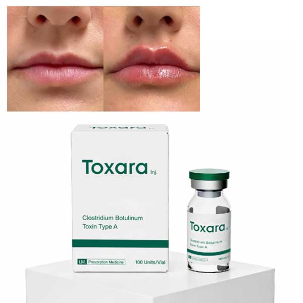 lip filler vs botulinum toxin
