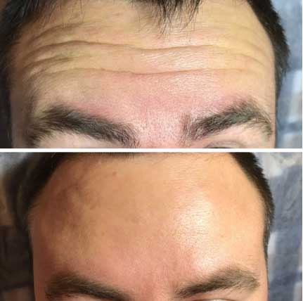 botulinum toxin for men befor and after