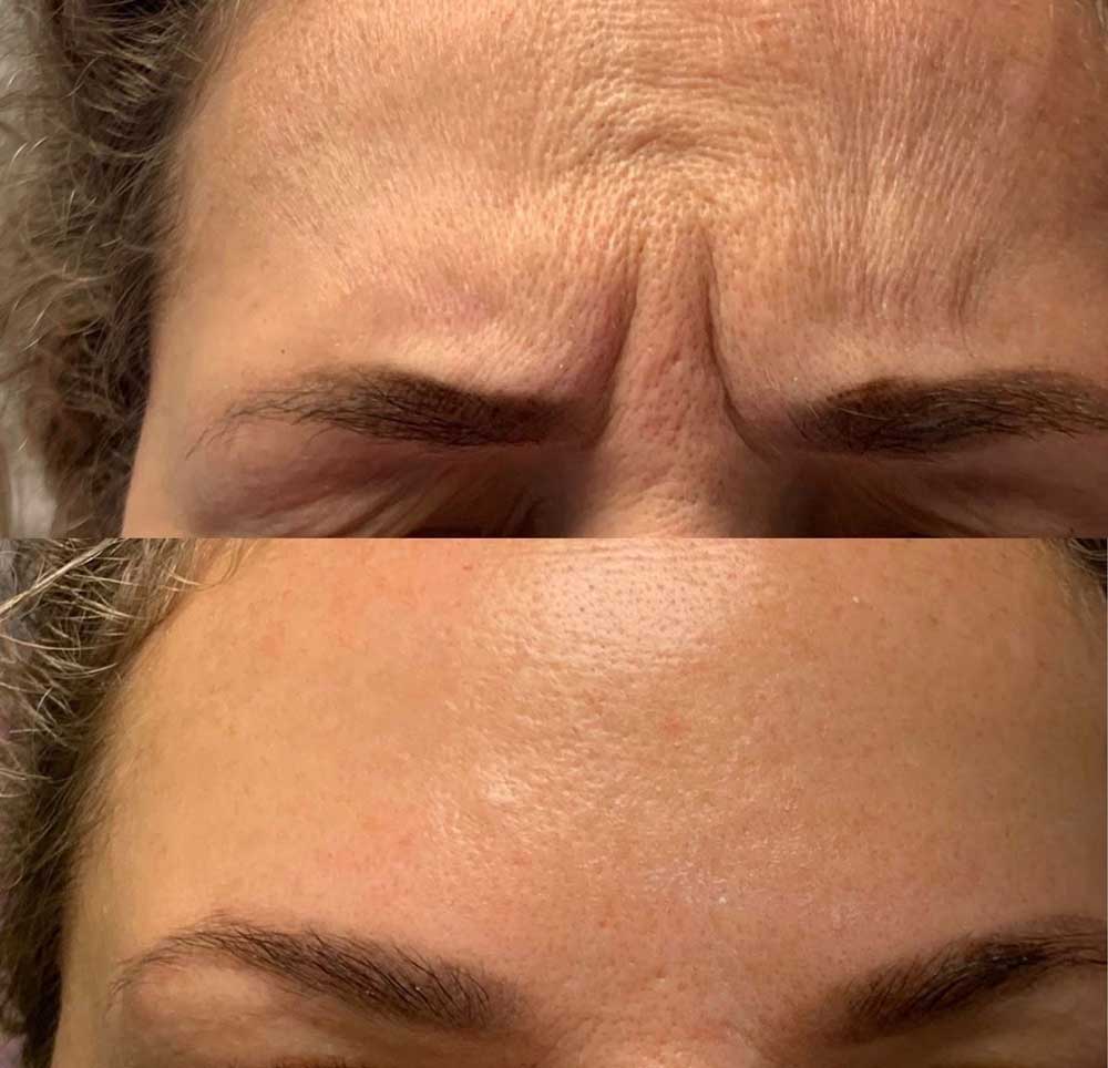 toxara 100 units clinical results