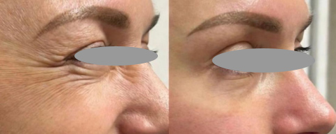 toxara 100 units clinical results